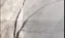 急診冠脈造影+支架植入術